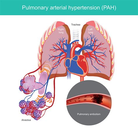 Pulmonary Arterial Hypertension in Patients with Primary ... - Hindawi