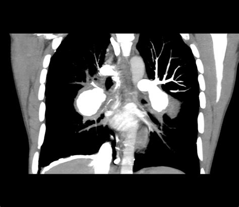 Pulmonary Artery Aneurysm - an overview ScienceDirect Topics