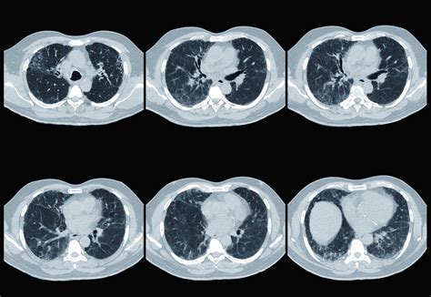 Pulmonary Complications in Sjögren