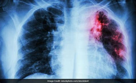 Pulmonary Fibrosis: 7 Effective Home Remedies - NDTV.com