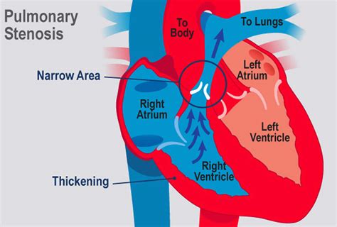 Pulmonary Stenosis: Causes and Symptoms - Massachusetts …