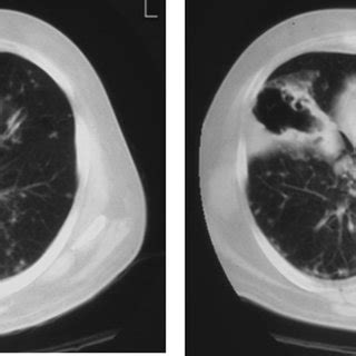 Pulmonary cryptococcosis: A review of pathobiology and clinical a…