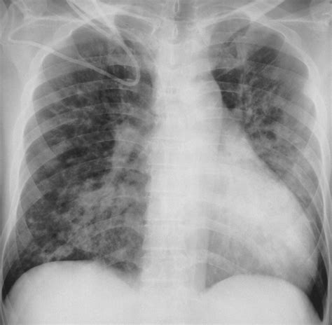 Pulmonary leukemic infiltratation Radiology Reference …