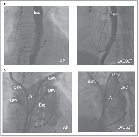 Pulmonary vein isolation‐induced vagal nerve injury and gastric ...