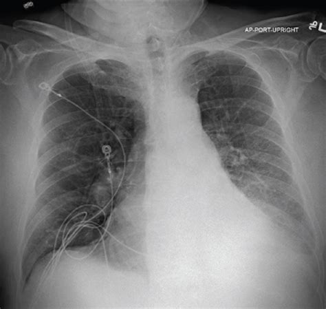 Pulmonx Cost of Zephyr Valve Treatment & Reimbursement …