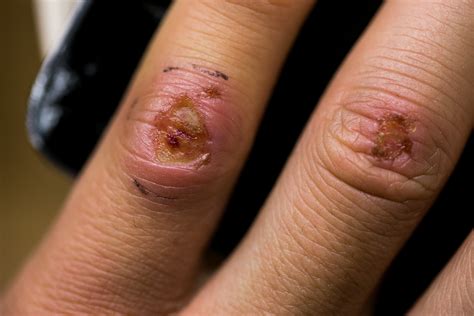 Puncture wound of finger - Dermatology - MedHelp