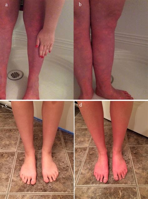 Exercise-induced vasculitis mainly affects one or both lower legs and thighs, with single or multiple episodes of a rash with the following characteristics: Involvement of exposed skin and sparing of skin protected by socks or stockings; Red patches, urticarial lesions (weals) and purpura (purple spots) Oedema (swelling) of the affected leg(s). 