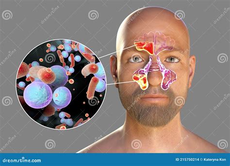 Purulent Inflammation of Frontal and Maxillary Sinuses in a Man and
