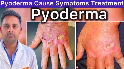 Pyoderma treatment cost.  [2] The disease was identified in 1908.  May 13, 2022 ·...