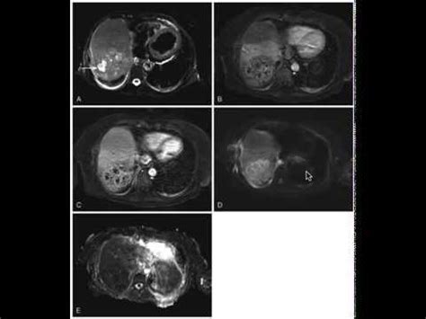 Pyogenic abscess vs Biloma - YouTube