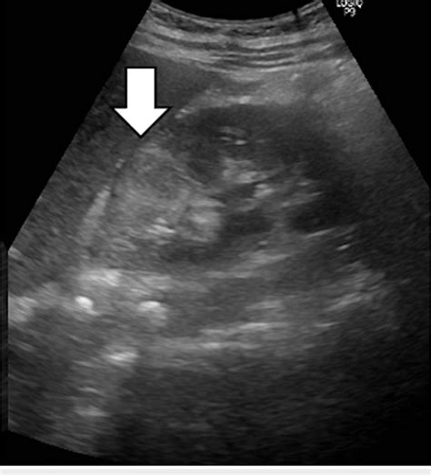 Pyuria and Urine Cultures in Patients with Acute Renal Colic