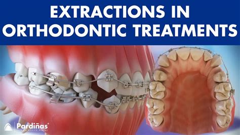 Q. Can braces retreatment be affected by teeth extraction?