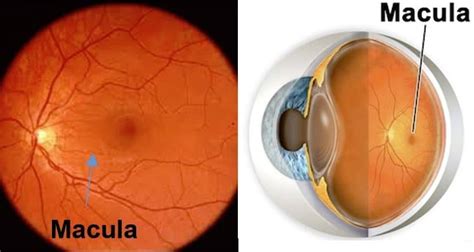 Qué es la DMAE seca - Asociación Mácula Retina