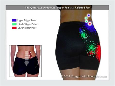 Quadratus Lumborum Trigger Points: Masters of Low Back