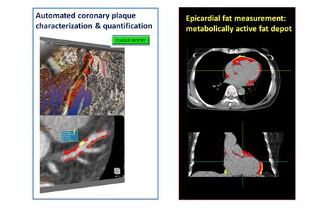 Quantitative Imaging Analysis Program Cedars Sinai
