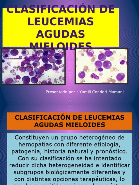 Que es leucemia mieloide aguda con t (8; 21); (q22; q22.1 ... - Salud