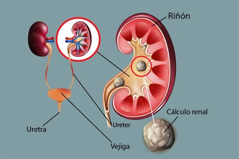 Que es litiasis renal izquierda.  &iquest;D&oacute;nde est&aacute; el bol&iacute;grafo con que escri...