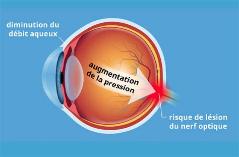 th?q=Quels+sont+les+signes+de+l'hypertension+oculaire+