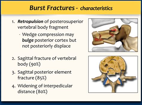 Question: What is a burst fracture with Retropulsion? - De Kooktips …