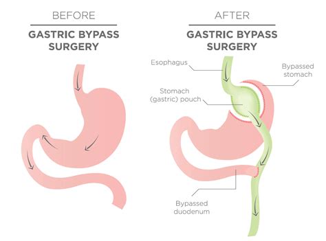 Question for those who have had bypass : r/BariatricSurgery