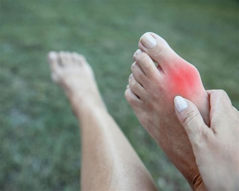 Questions About Bunion... - Eastside Foot and Ankle, LLC