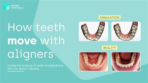 Quick, patient-friendly clear aligners British Dental Journal