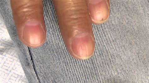 Quincke's sign, otherwise known as Quincke's pulse, is a nail sign: it is seen when the nailbed is blanched. The pale nail bed flashed red and white as capillary refill is restored. The pale nail bed flashed red and white as capillary refill is restored.. 