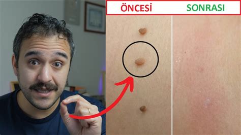 Rüyada Vücutta Et Beni Çıkması .