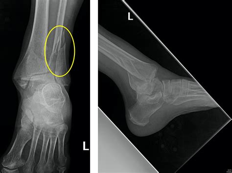 Unspecified fracture of right lower leg, initial encounter for clos