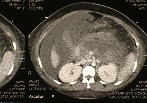 RACGP - Chronic pancreatitis: Negotiating the …