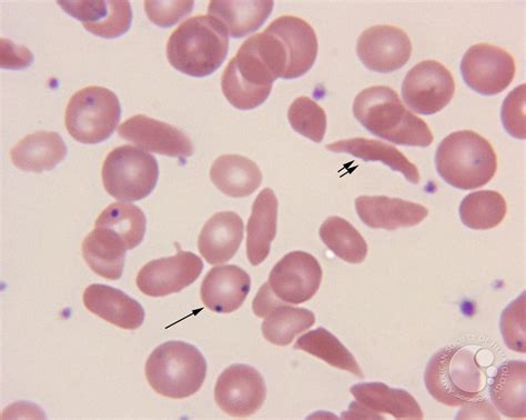 RBC Morphology in Sickle Cell Disease (HbSS) - LabCE