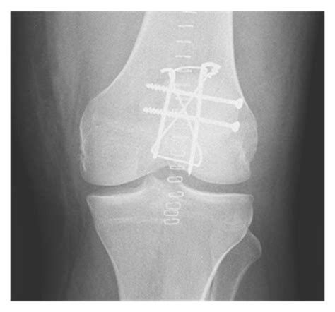 REHABILITATION GUIDELINES FOR PATELLA FRACTURE POST …