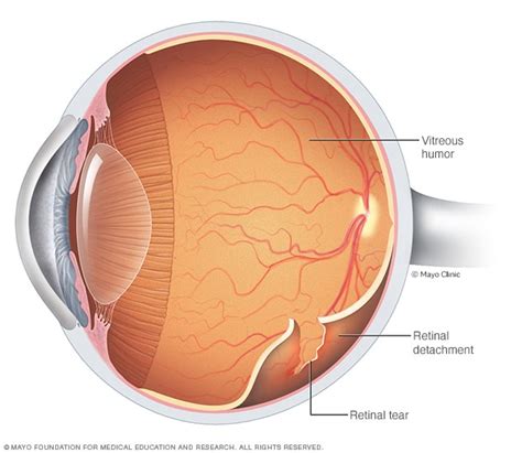 Retinal detachment - Diagnosis and treatment - Mayo Clinic - wintechmobiles.com