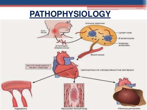 RHEUMATIC HEART DISEASE PATHOPHYSIOLOGY RHEUMATIC HEART DISEASE