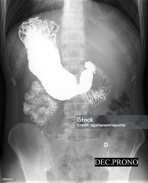 Rontgen Perut Lambung - wintechmobiles.com