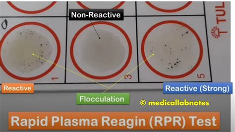 RPR Test Introduction, Principle, Procedure, ResultInterpretation