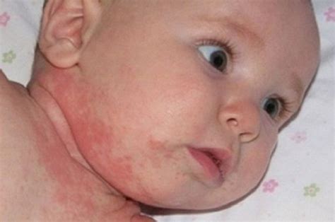 Ruam Pada Wajah Bayi - balustradellc