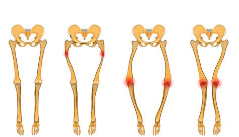 Rachitis - Ursachen, Symptome & Behandlung MedLexi.de