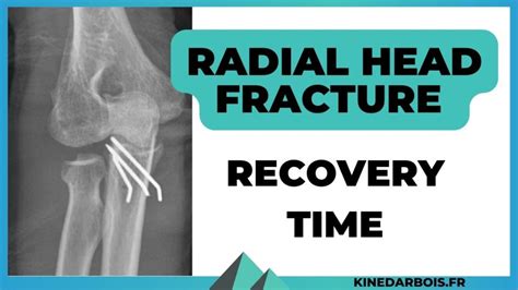 Radial Head Fracture Recovery Time What You Need to Know