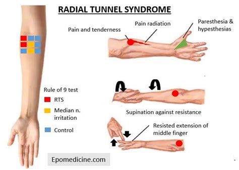 Radial tunnel injection cpt. The tendons and nerve to the hand (median nerve) passes between strong ligaments (carpal ligaments) in the wrist and the wrist bones (carpal tunnel). The tendons and nerve to the h... 