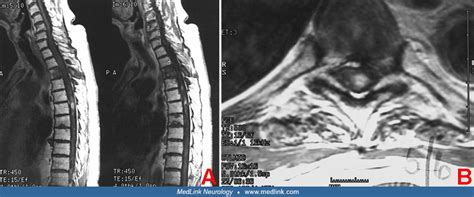 Radiation myelopathy MedLink Neurology