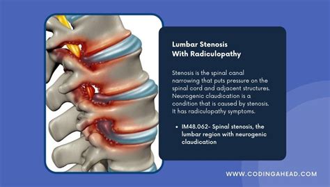 Radiculopathy lumbar region icd 10. 500 results found. Showing 1-25: ICD-10-CM Diagnosis Code M54.16 [convert to ICD-9-CM] Radiculopathy, lumbar region. Lumbar radiculopathy. ICD-10-CM Diagnosis Code M48.06. Spinal stenosis, lumbar region. Lumbar spinal stenosis no neurogenic claudication; Lumbar spinal stenosis w neurogenic claudication; Myelopathy due to spinal stenosis of ... 