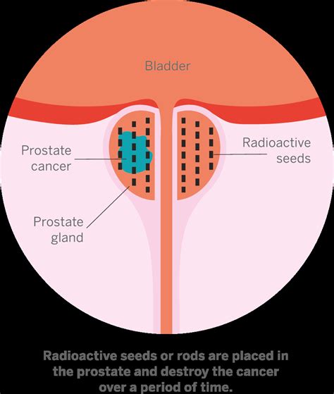 Radioactive ‘seeds’ boost for patients with prostate cancer