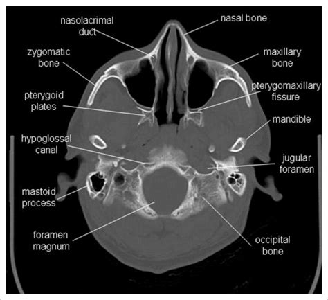 Radiographic Anatomy of the Orbit and Visual Pathways