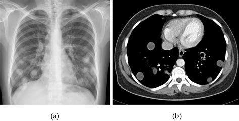 Radiological manifestations of thoracic hydatid cysts: pulmonary …