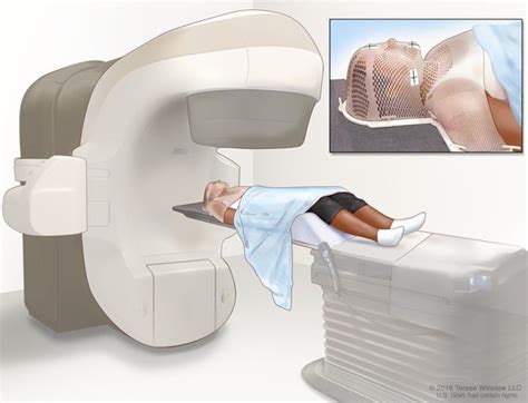 Radioterapia de haz externo para el cáncer - NCI