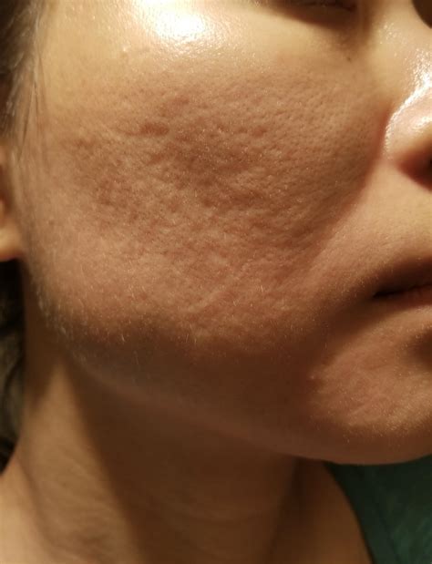 Raised acne scars. .  <a href=https://findlamp.ru/cymxwzp/fetch-com-au-account...