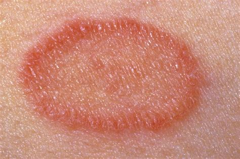 Random Circle Shaped Red Hives - Dermatology - MedHelp