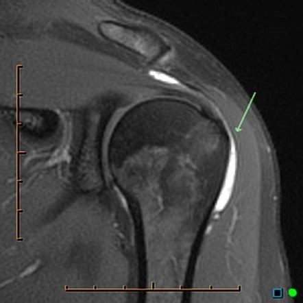 Range of Normal and Abnormal Subacromial/Subdeltoid Bursa Fluid