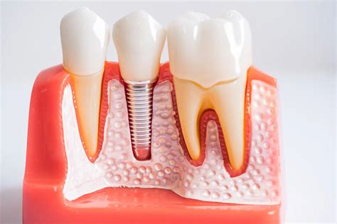 Ranking implantów zębowych – o tym warto wiedzieć!